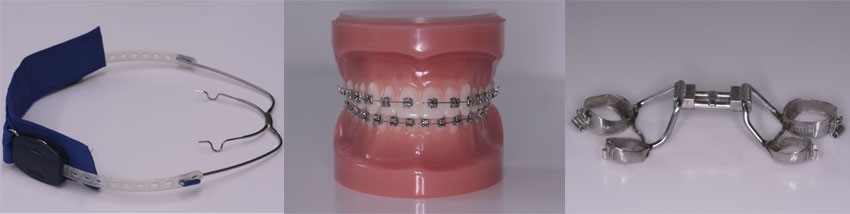 Eerste voorbeeld soorten beugels Orthodontist